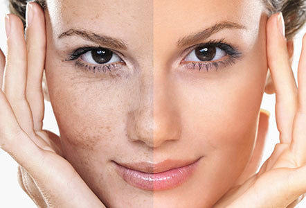 Best Serum for Hyperpigmentation Treatment